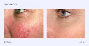 Rosacea Photofacial Photorejuvenation Southfield MI