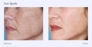 Sun Spots Photofacial Photorejuvenation Southfield MI