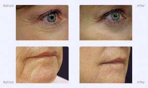 Laser Skin Tightening CoolTouch Southfield MI