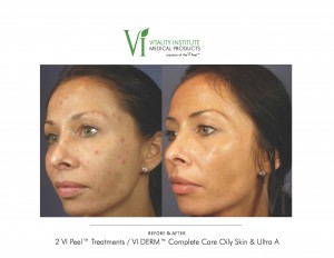 VI Peel Before and After Acne Southfield MI