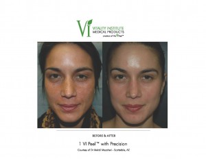 VI Peel Before and After Pigmentation Southfield MI
