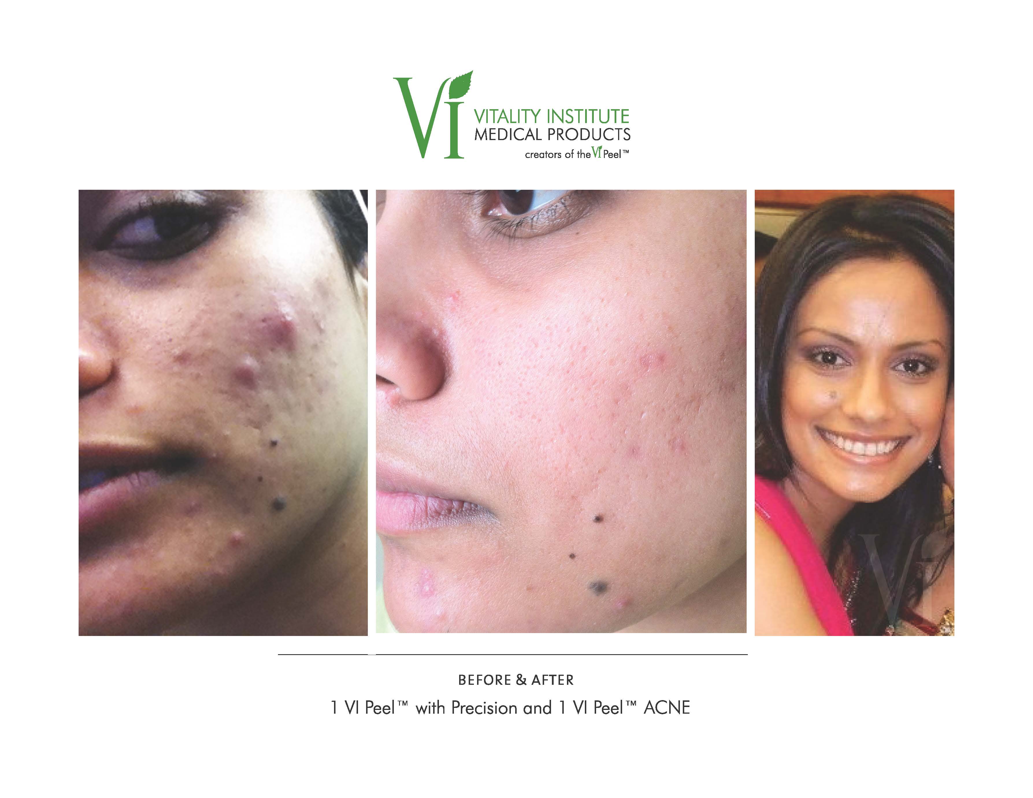 VI Peel Before and After Precision and Acne Southfield MI