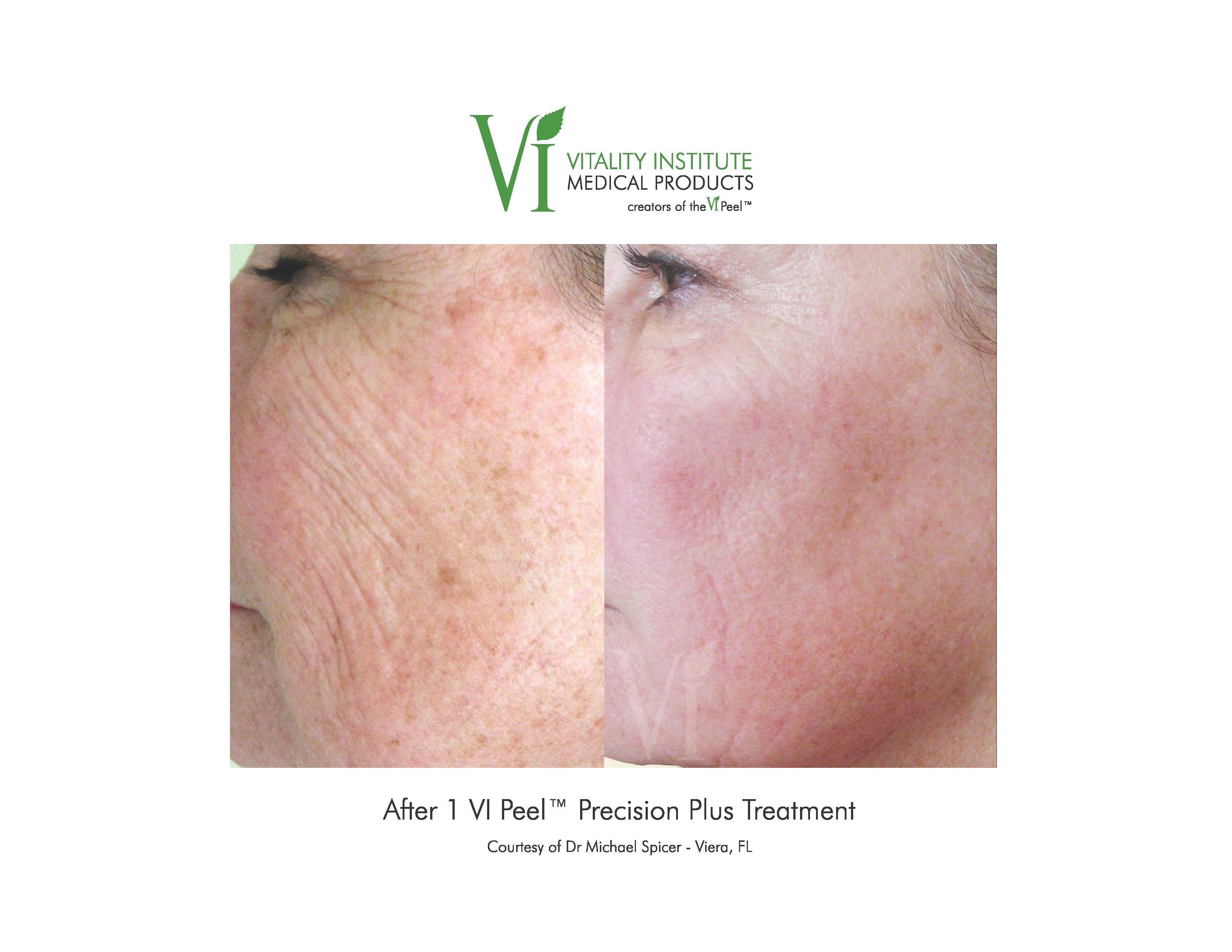 VI Peel Wrinkles Before and After Southfield MI