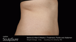 Sculpsure-Body-Contouring-Before-After-southfield-mi