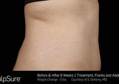 Sculpsure-Body-Contouring-Before-After-southfield-mi