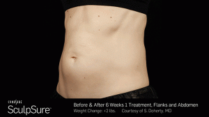 Sculpsure-Body-Contouring-Before-After-southfield-mi