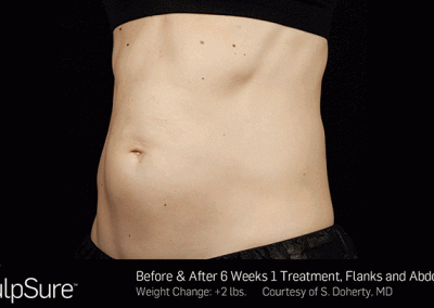 Sculpsure-Body-Contouring-Before-After-southfield-mi