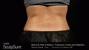Sculpsure-Body-Contouring-Before-After-southfield-mi