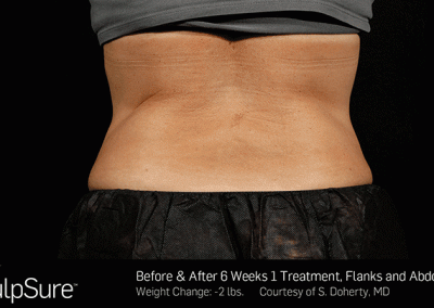 Sculpsure-Body-Contouring-Before-After-southfield-mi
