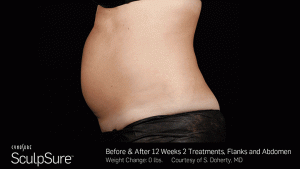 Sculpsure-Body-Contouring-Before-After-southfield-mi