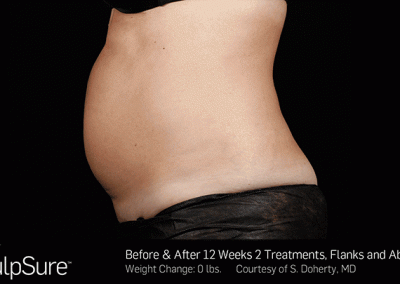 Sculpsure-Body-Contouring-Before-After-southfield-mi