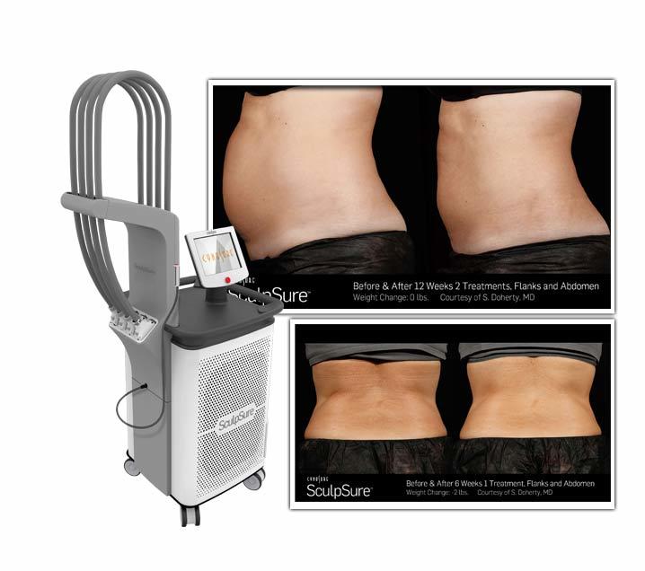 Best Non-Invasive Body Contouring, SculpSure Maryland