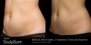 Sculpsure-Body-Contouring-Before-and-After-1.jpg