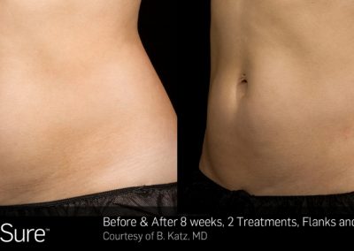 Sculpsure-Body-Contouring-Before-and-After-1.jpg