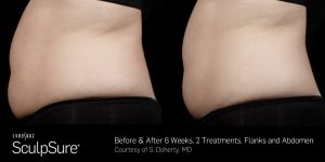 Sculpsure-Body-Contouring-Before-and-After-2.jpg