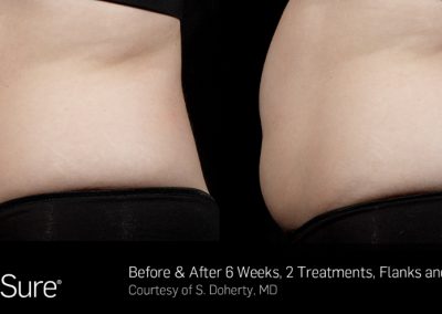 Sculpsure-Body-Contouring-Before-and-After-2.jpg