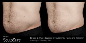 Sculpsure-Body-Contouring-Before-and-After-3