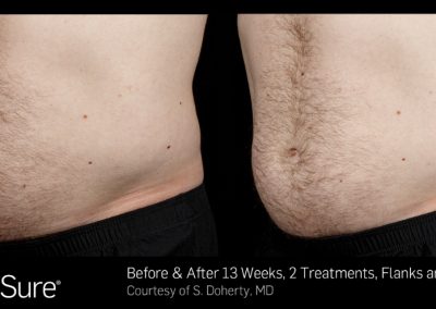 Sculpsure-Body-Contouring-Before-and-After-3