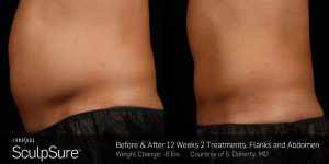 Sculpsure-Body-Contouring-Before-and-After-4
