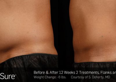Sculpsure-Body-Contouring-Before-and-After-4