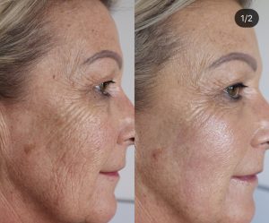 Plasma-Fibroblast-Lift-Skin-Tightening-Treatment-Southfield-Michigan