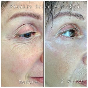 fibroblast tightening pigalle southfield