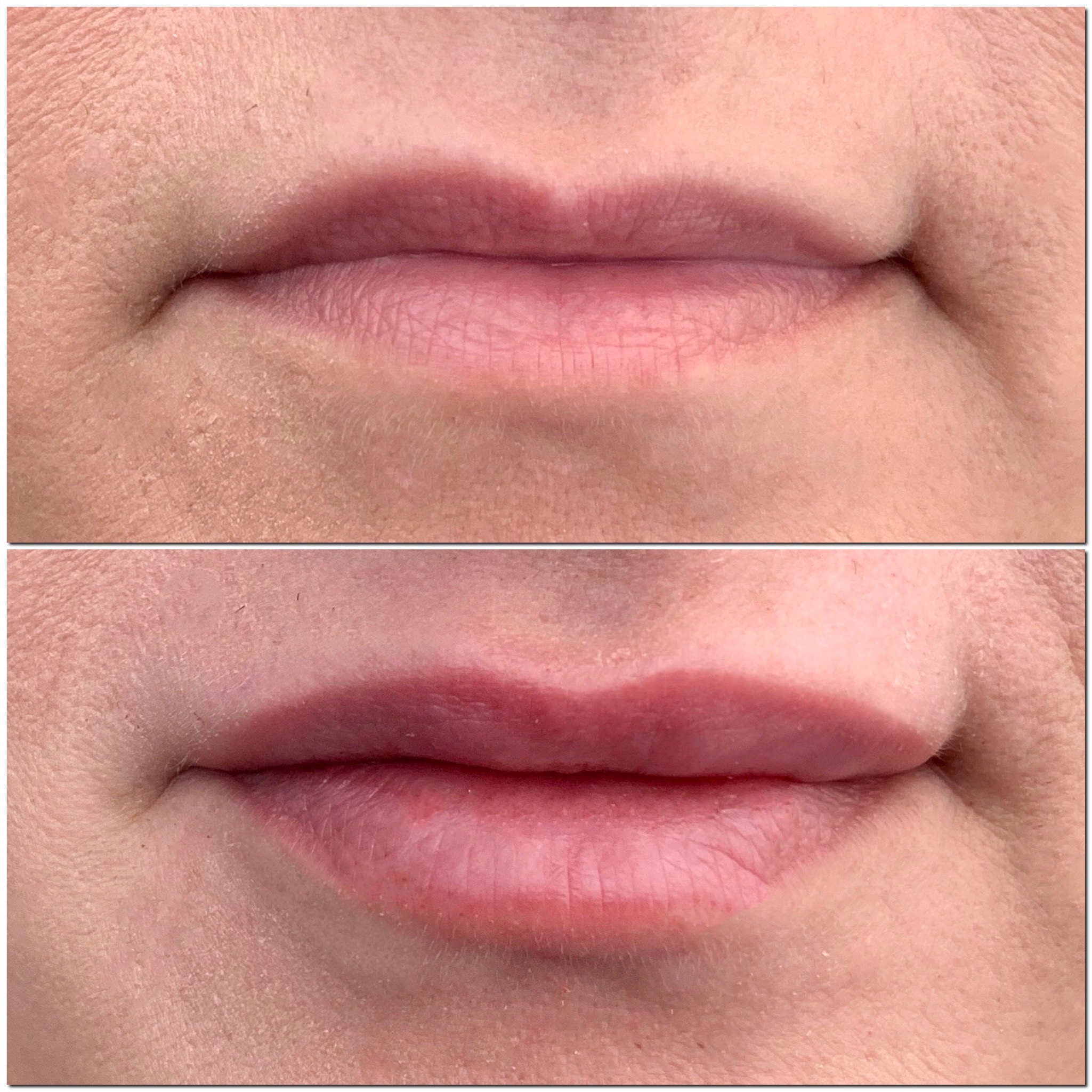 Hyaluron-Pen-Filler-Treatment-Southfield-MI-before-after