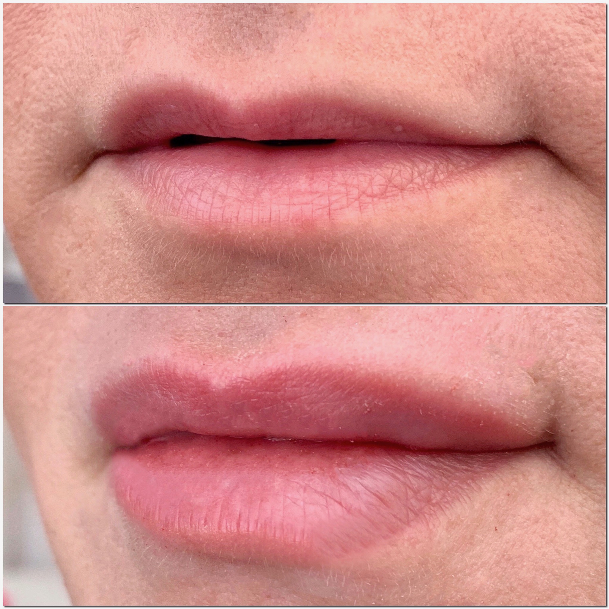 Hyaluron-Pen-Filler-Treatment-Southfield-MI-before-after